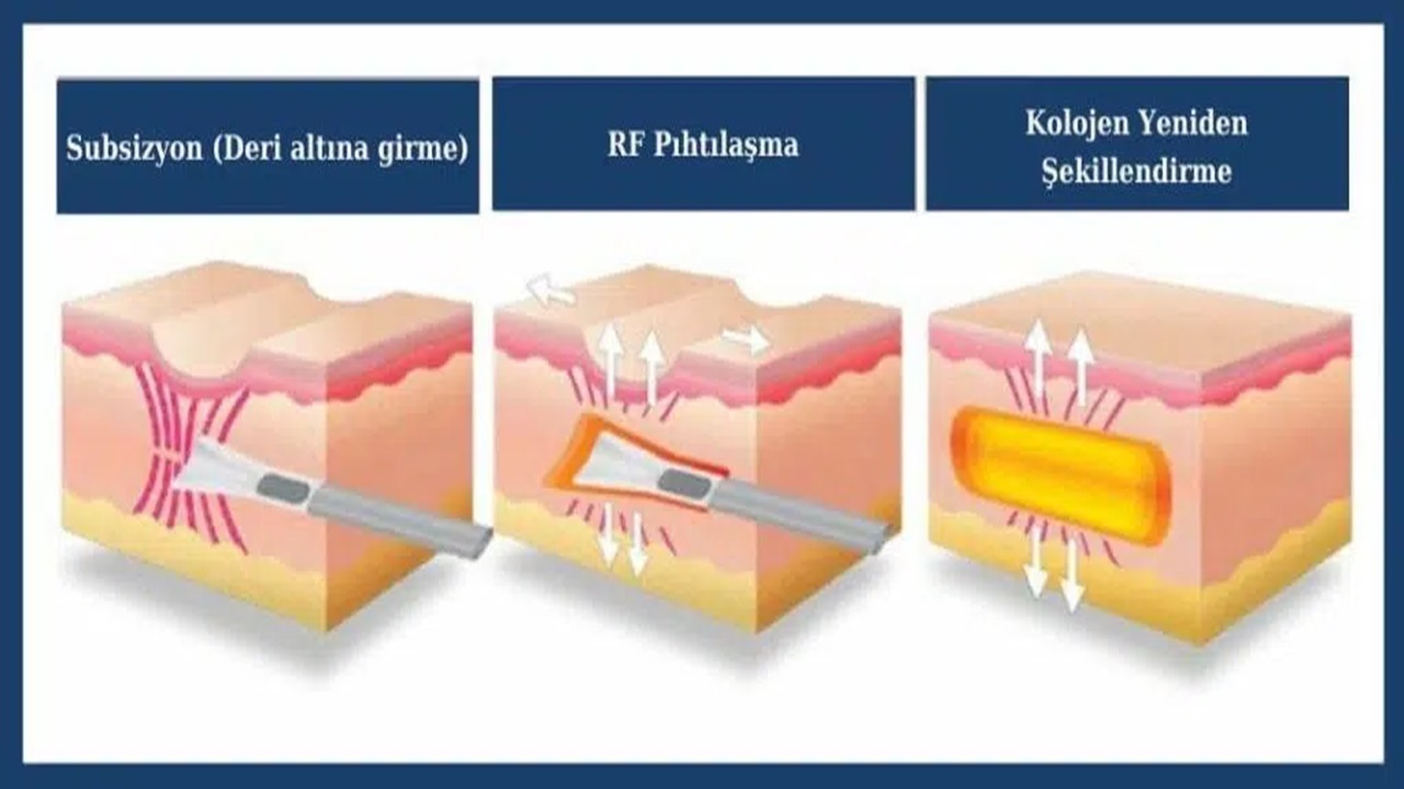 Sivilce Tedavisi ile Genç ve Sağlıklı Cildin Sırları